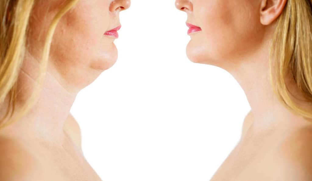 Double Chin treatment Liphook before and after results