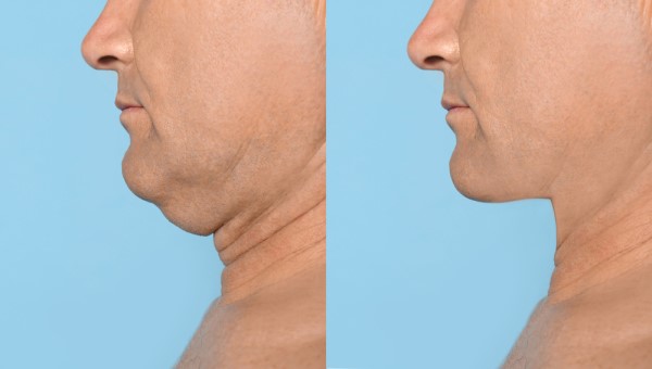 Which Non-Surgical Treatments Work Best for Jowls and Loose Skin Liphook?