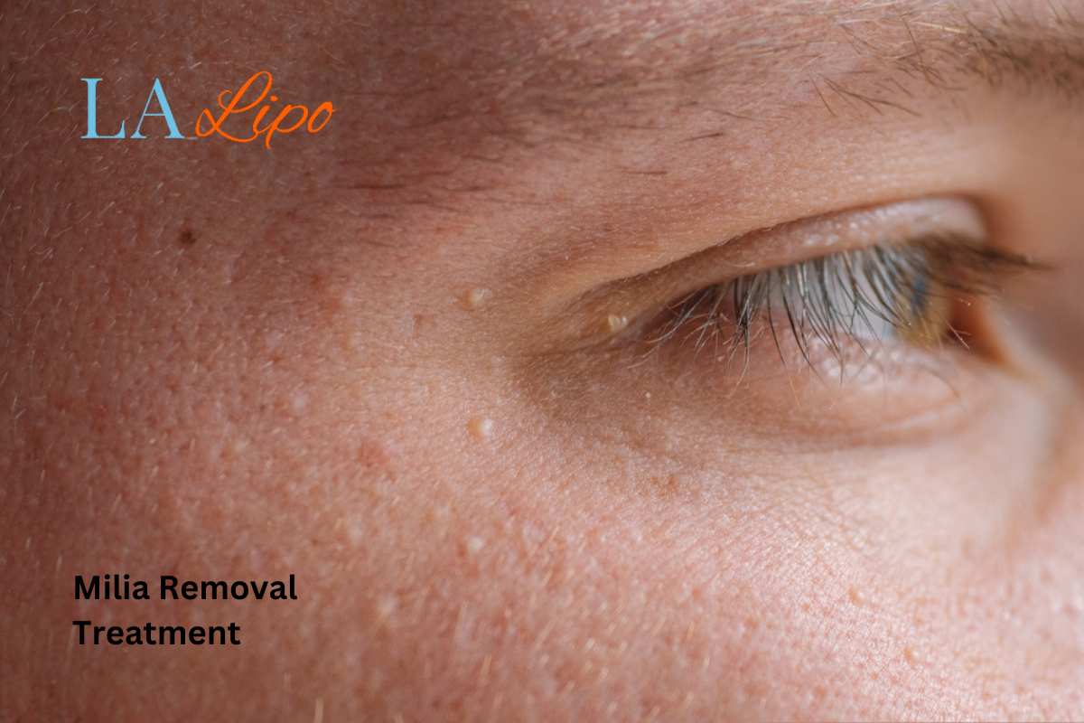 Cryopen Milia Removal: Is It the Easiest and Safest Option Liphook?