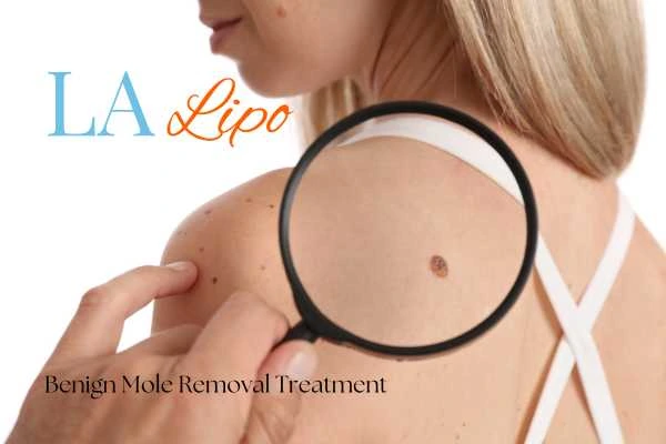 Woman having her inspection of blemish before mole removal Liphook
