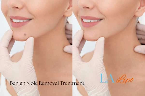woman's before and after mole removal Liphook results