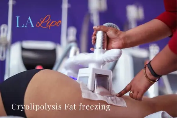women getting fat freezing Liphook