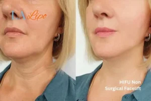 hi-fu for wrinkles Liphook before and after results