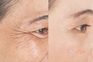 Before and after results of woman - HI-fu wrinkles reduction treatment Liphook