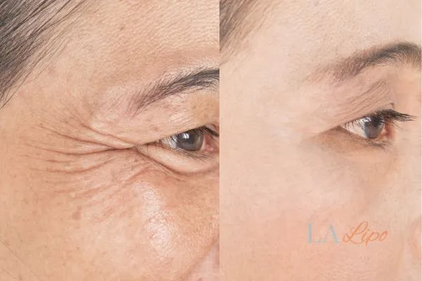 Before and after results of woman - HI-fu wrinkles reduction treatment Liphook