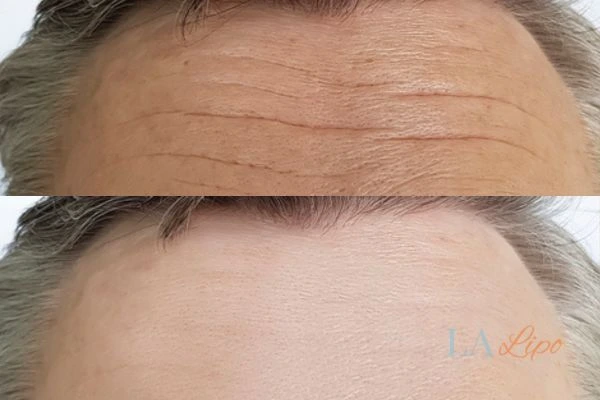 results of HIFU Liphook on mans forehead to help reduce lines and wrinkles