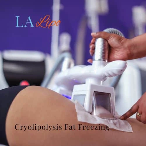 fat freezing - Cryolipolysis Liphook