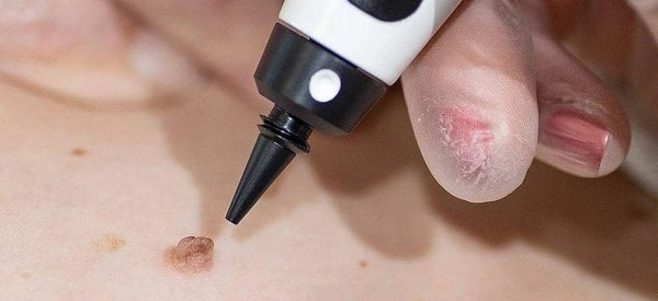 skin tag removal using cryopen Liphook
