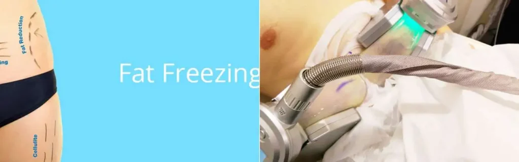 Fat freezing Liphook on multiple areas of the body