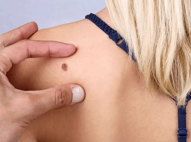 woman having mole removal Liphook consultation before treatment.
