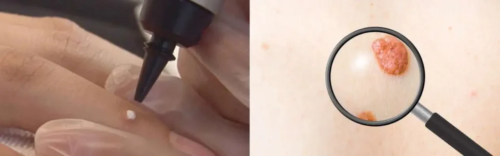 Cryopen for mole removal Liphook - speak to our team today!
