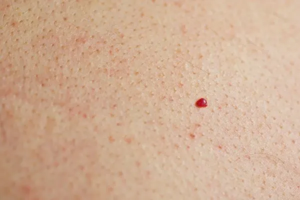 close up of a cherry angioma Liphook