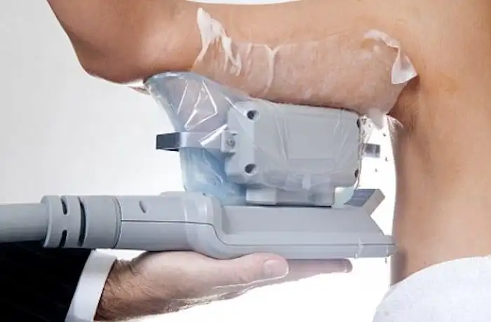 Picture of fat freezing Liphook on the upper arms.