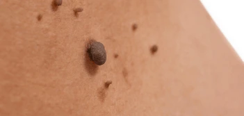 image of a skin tag Liphook