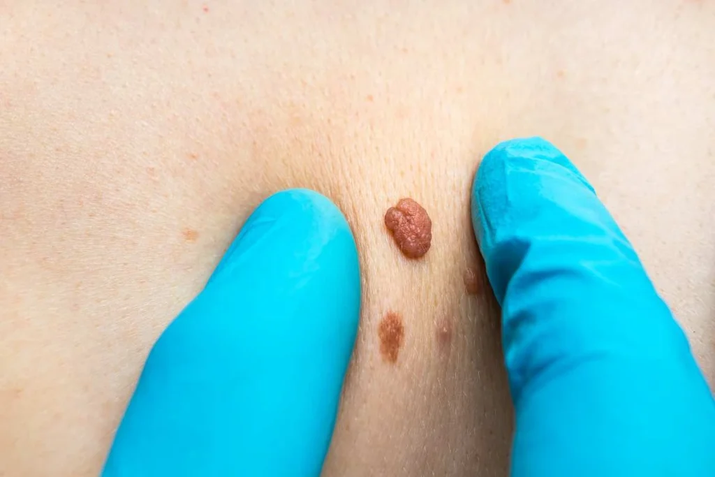 Consultant examining a skin tag Liphook
