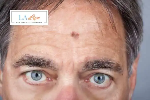 Solar Lentigo Removal Liphook image of man with mark on his forehead