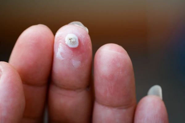 wart on person finger - cryotherapy to treat from LA LIPO Liphook