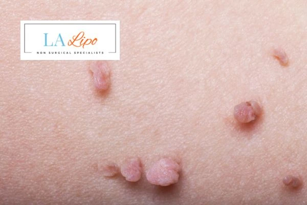Does cryopen skin tag removal Liphook hurt? Find out now call our team today!