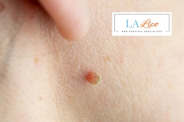 Book skin tag removal Liphook today speak to our team now!