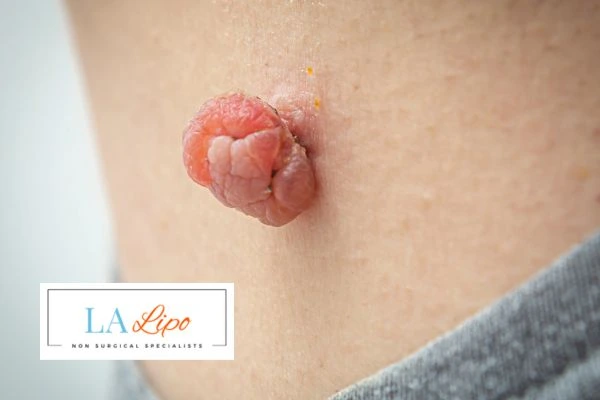 Interested in skin tag removal Liphook? Concerned about the pain? Find out more today!