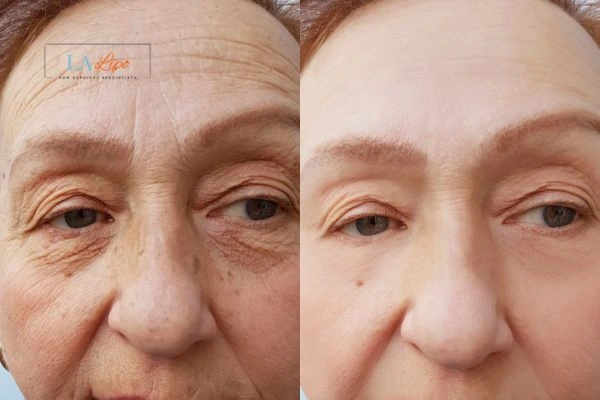 The powerful benefits of Morpheus8 Treatment Liphook - Call Our team today!