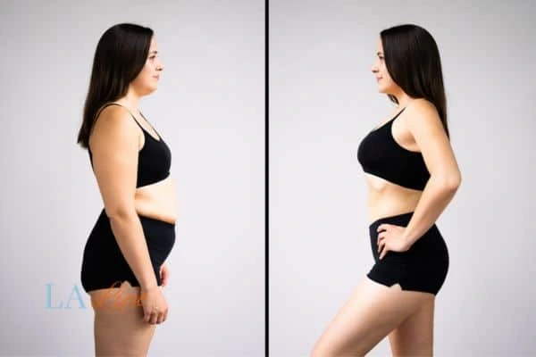 Picture of womans before and after using LA-EMS body sculpting to improve her core strength Liphook
