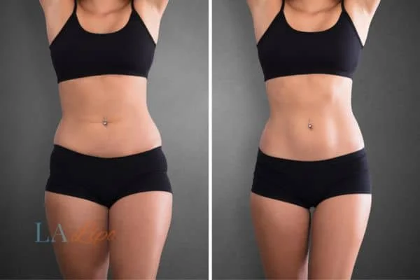before and after results of non-surgical treatment to help a woman's body image and mental health Liphook