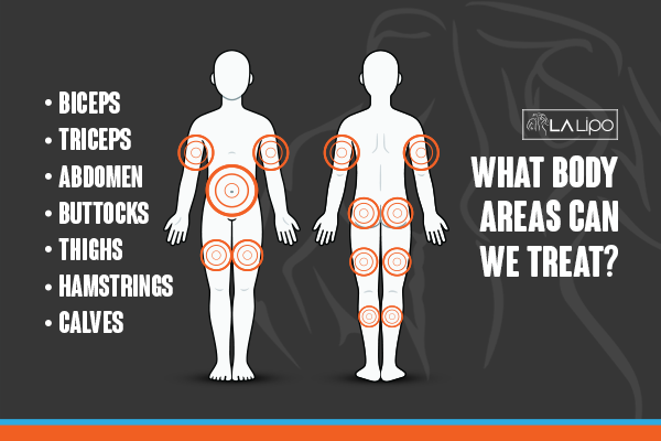 Diagram to show areas you can have LA-EMS Body Sculpting Treatment Liphook