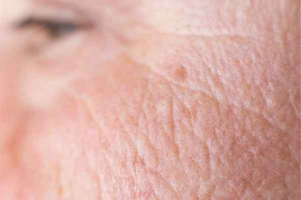 close up picture of a woman's face showing an age spot Liphook