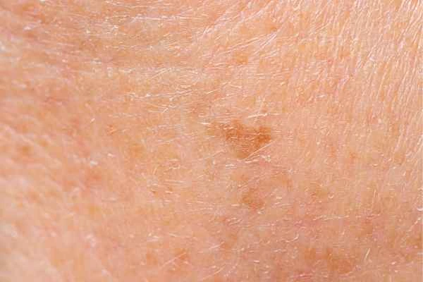 close up picture of age spots Liphook