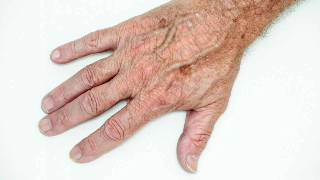 Male hand showing age spot Liphook