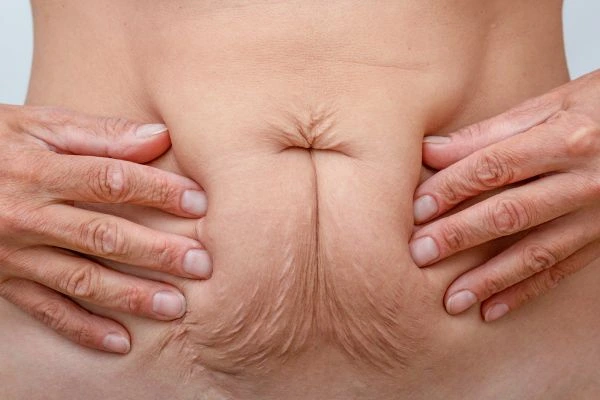 Image of a woman's stomach with loose skin - example of skin tightening Liphook options