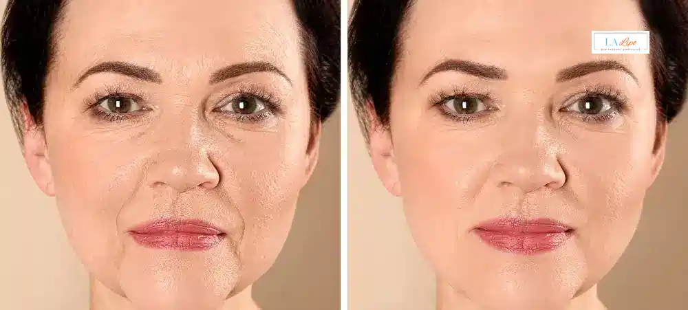 How Long Does It Take to See Results and How Long Do They Last Liphook?