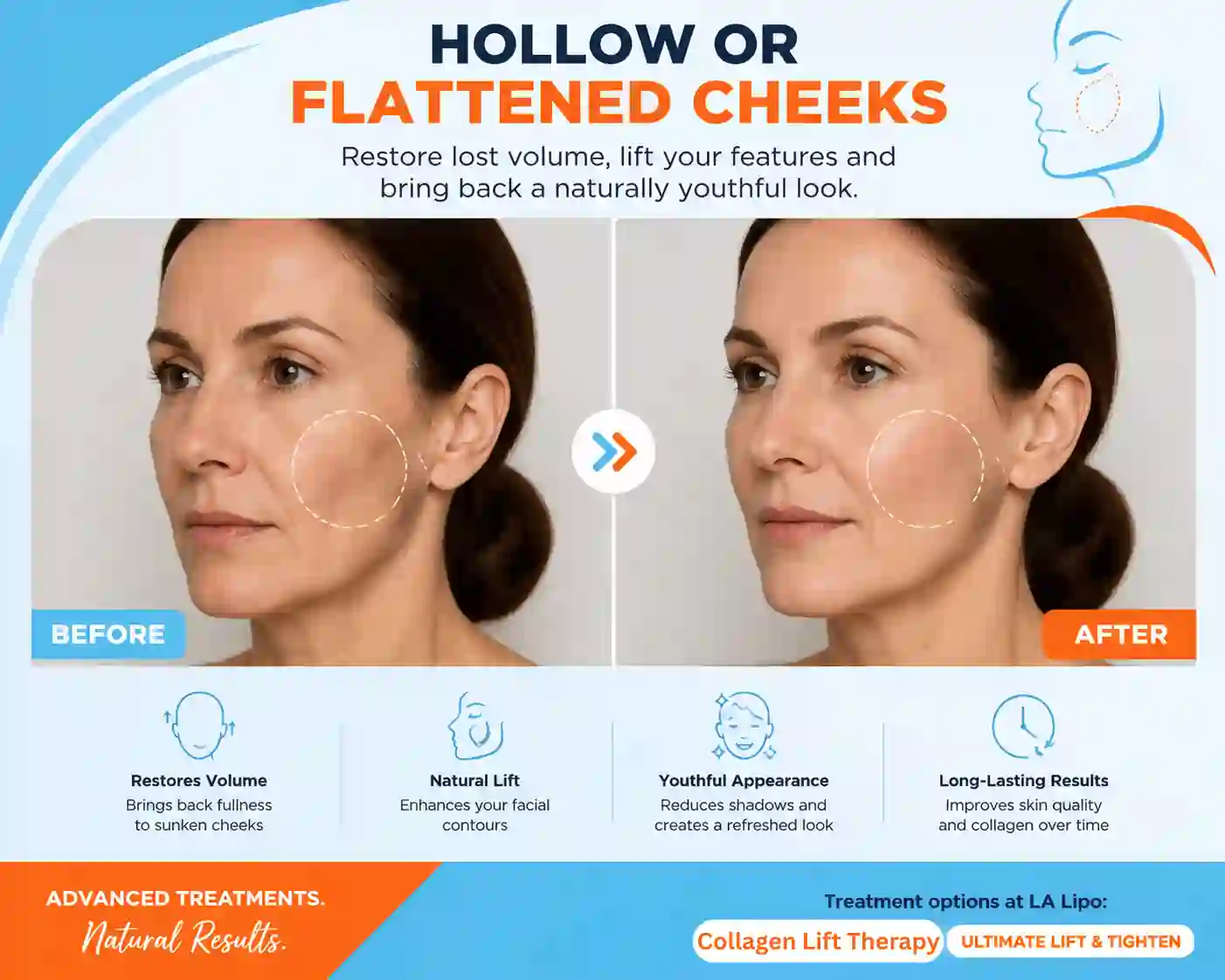 Sign #4: Hollow or Flattened Cheeks Liphook